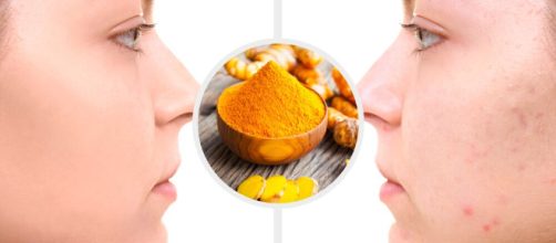 &iquest;C&uacute;rcuma para eliminar las cicatrices del acn&eacute;?