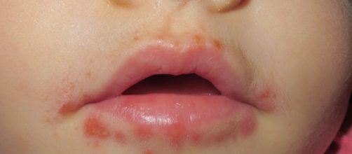 Ni&ntilde;o con S&iacute;ndrome boca-mano-pie