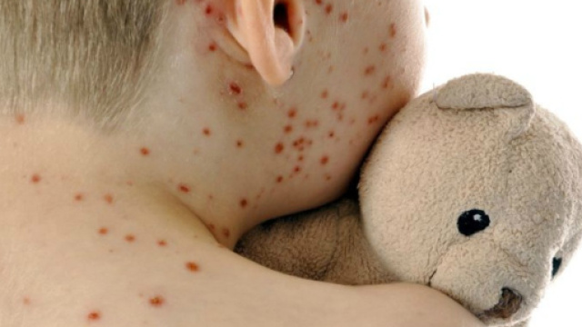 Epidemia di morbillo: si apre il &lsquo;caso Sicilia&rsquo;