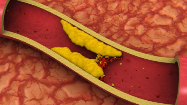 Un alimento se consumato tutti i giorni previene ictus e infarto