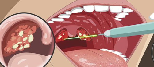 Qu&eacute; son esas bolitas blancas que huelen mal y salen de mi garganta?