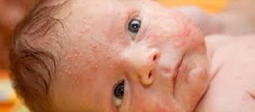 Mi beb&eacute; reci&eacute;n nacido tiene alergia &iquest;qu&eacute; hago?