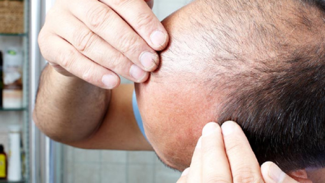 L'efficacia dei rimedi naturali per contrastare la calvizie: i ... - tricomedit.it