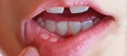 Aftas bucales: un transtorno comun - El despertar interno - eldespertarinterno.es