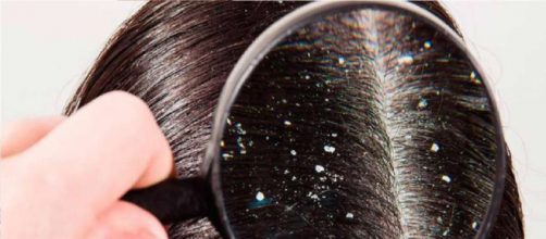C&oacute;mo combatir la caspa en el cabello