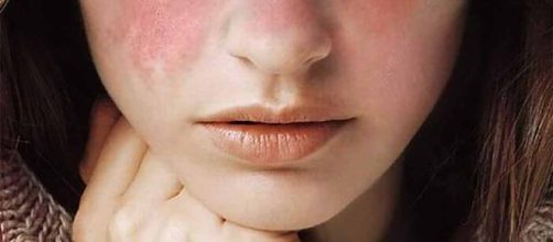 Lupus: &iquest;Se puede prevenir? &iquest;Existe alg&uacute;n tratamiento?