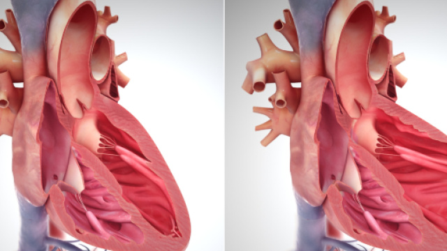 Scompenso cardiaco, seconda causa di morte in Italia