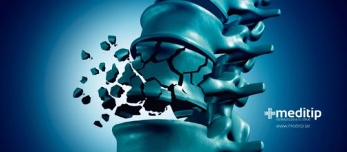 La osteoporosis puede ser irreversible, pero hay maneras que ayudan a evitar la p&eacute;rdida de hueso