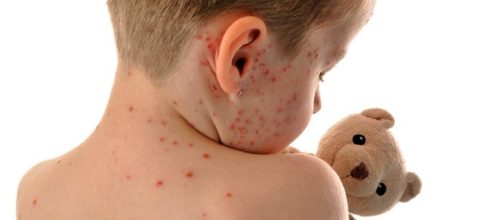 Lo que no se sabe del Sarampi&oacute;n en la Am&eacute;ricas