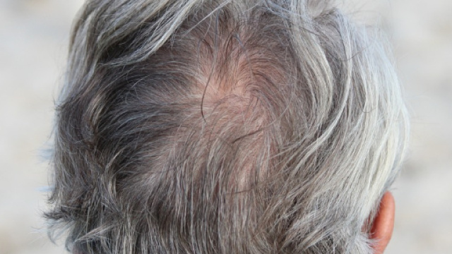 Capelli bianchi e salute, le cose da sapere (Ph. Pixaby.com - Elektro Plan)