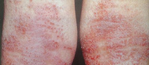 Confira como tratar de forma eficaz a dermatite e a psor&iacute;ase