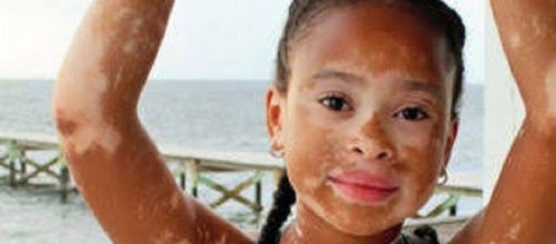 Vitiligo: una enfermedad cut&aacute;nea autoinmune