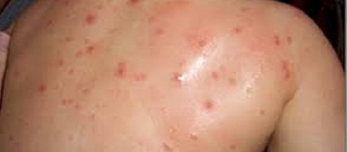 Eruptiva de la infancia: varicela