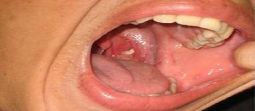 Voc&ecirc; sabe o que &eacute; aquela bolinha fedida na garganta?