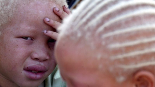 UN Resettles Albino Refugees Due to Threats in Malawi - voanews.com