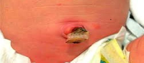 La onfalitis:infecci&oacute;n potencialmente mortal