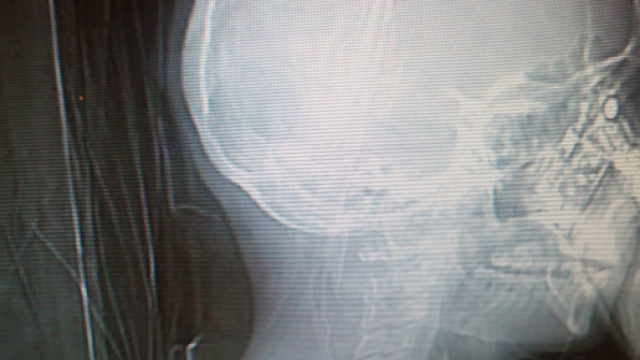 Donna risponde al telefonino durante la tac