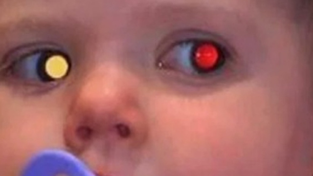 Gran Bretagna, la neonata ha un cancro all'occhio: i genitori lo scoprono da una foto