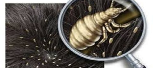 La pediculosis es un problema que generalmente afecta a ni&ntilde;os de edad escolar.