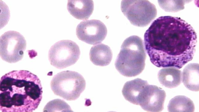 Leucemia: parecchia igiene pu&ograve; favorirne la comparsa in et&agrave; infantile