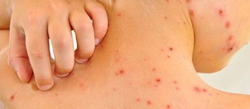 Varicela complicada: una enfermedad potencialmente mortal