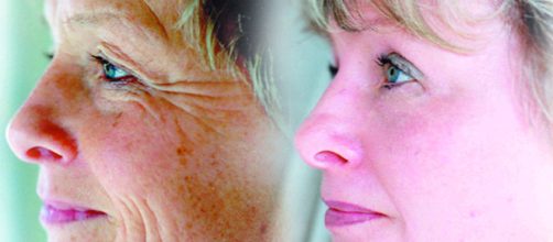 Veneno de serpiente para un rostro sin arrugas