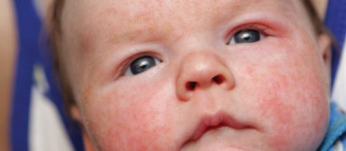 Dermatite at&oacute;pica: alimentos que voc&ecirc; deve evitar