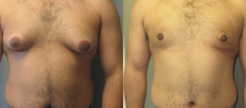 O que &eacute; Ginecomastia e Como Eliminar