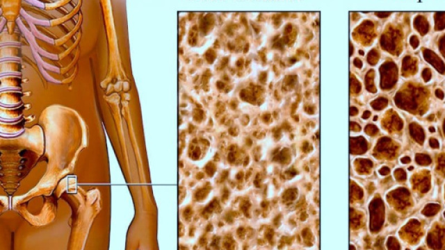 Dieta ed allenamento per combattere l'osteoporosi.
