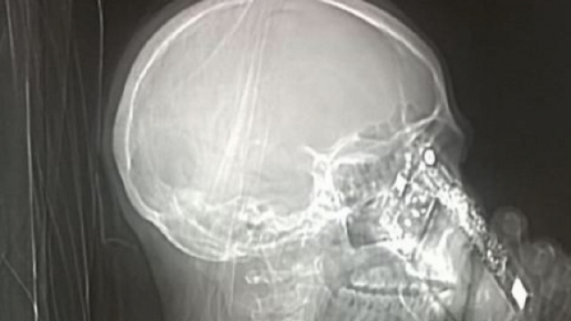 Napoli, si sottopone alla Tac con il cellulare - infoglitz.com