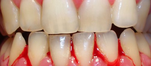 &iquest;Por qu&eacute; nos sangran las enc&iacute;as?