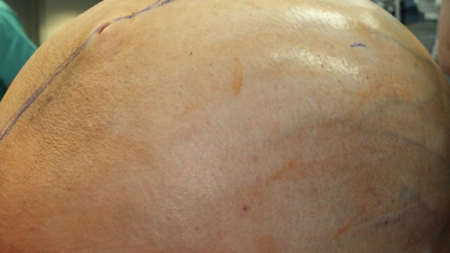 Va in ospedale con tumore ovarico da 60 chili.