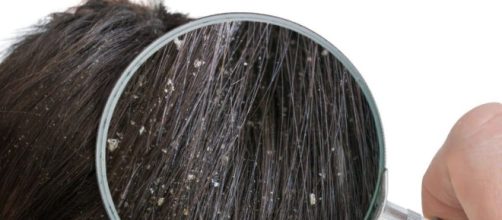 Os 10 rem&eacute;dios caseiros para eliminar a caspa.