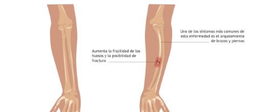 &iquest;Qu&eacute; es la osteog&eacute;nesis imperfecta?