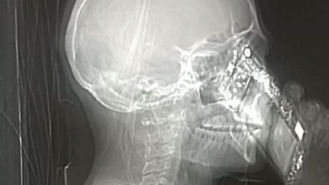 Incredibile a Napoli. Donna entra nella Tac col cellulare