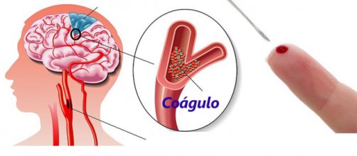 Como salvar a una persona de un derrame cerebral