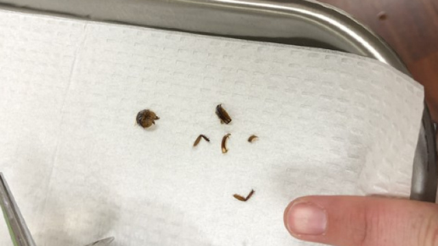 Resti di uno scarafaggio estratti dall'orecchio dell'americana Katie Holley.