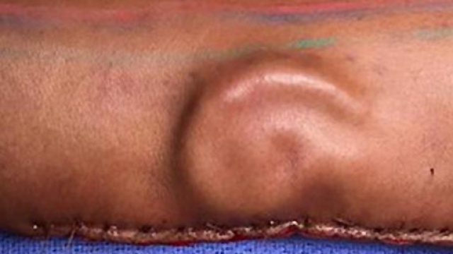 Orecchio fatto crescere nel braccio della paziente: l'incredibile intervento