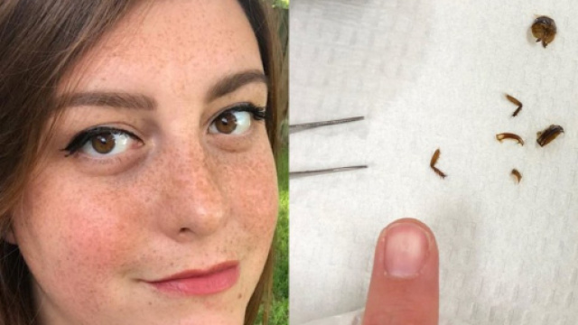 Vive con uno scarafaggio nell'orecchio per 9 giorni