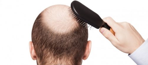 Cientistas do Reino Unido est&atilde;o desenvolvendo tratamento promissor para a calv&iacute;cie