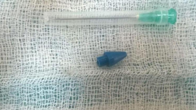 Indiano scopre di avere punta di penna a sfera nel pene