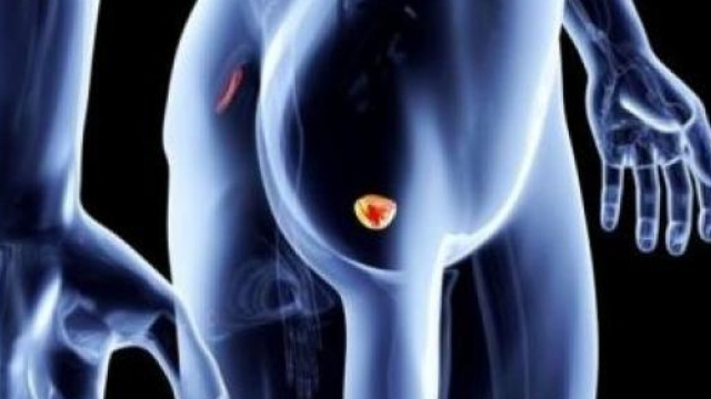 Tumore alla prostata: quali sono gli uomini che rischiano di pi&ugrave; - blastingnews.com
