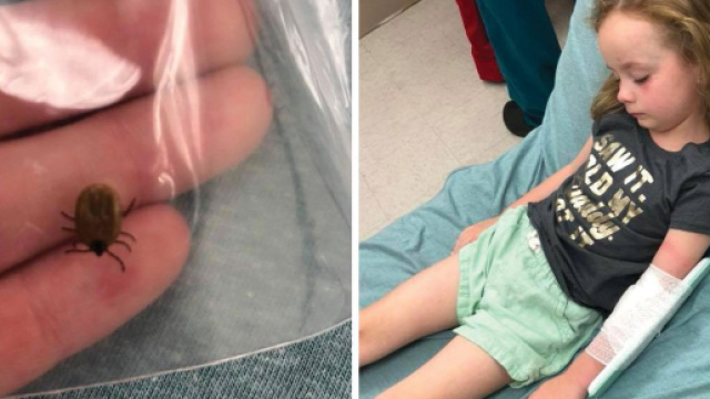 Usa, paralisi temporanea dopo la puntura di una zecca