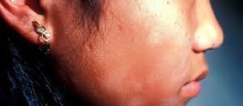 Asociaci&oacute;n del sol con la pitiriasis alba