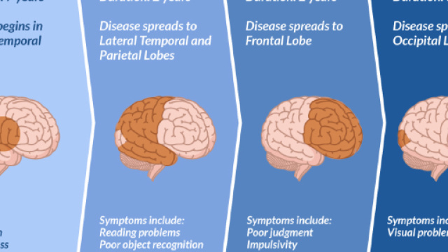 Alzheimer ed herpesvirus umano
