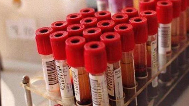 Dal prelievo di sangue si pu&ograve; sapere come i bambini epilettici risponderanno ai farmaci