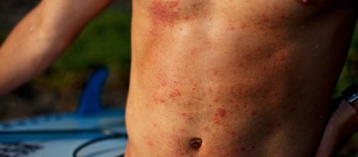 EE.UU / 'Piojos de mar' molestan a los ba&ntilde;istas en playas de Florida este verano