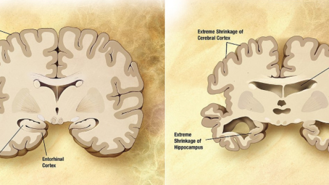 La malattia di Alzheimer forse &egrave; collegata alla presenza di herpes virus
