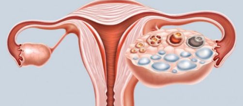 Ov&aacute;rios Polic&iacute;sticos ou S&iacute;ndrome dos Ov&aacute;rios Polic&iacute;sticos: como prevenir?