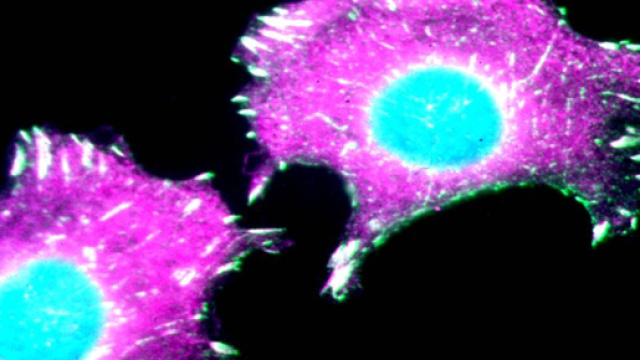 Cancro al seno, donna curata nel Maryland utilizzando le sue stesse cellule.